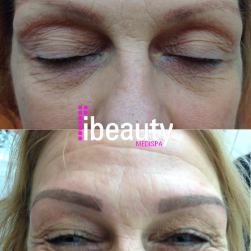 eyebrow before after 8